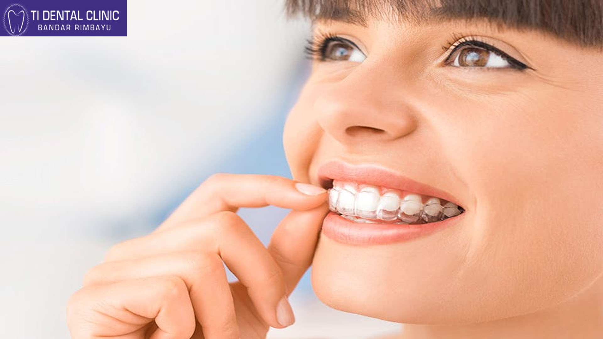 Invisible Braces Dentist Aligning Teeth Without Notice (Tidental